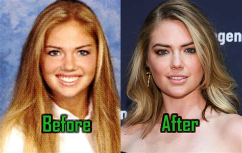 Kate Upton Before and After Plastic Surgery: Boobs